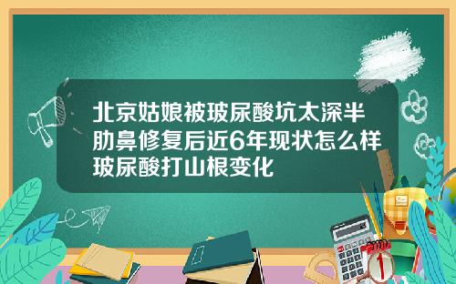 北京姑娘被玻尿酸坑太深半肋鼻修复后近6年现状怎么样玻尿酸打山根变化