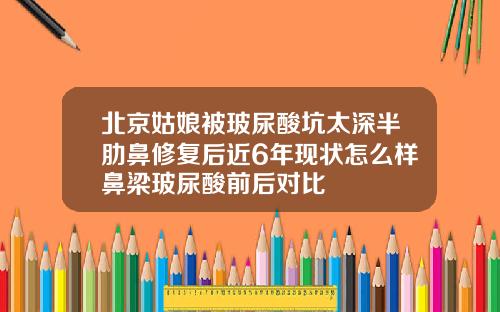 北京姑娘被玻尿酸坑太深半肋鼻修复后近6年现状怎么样鼻梁玻尿酸前后对比