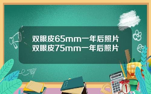 双眼皮65mm一年后照片双眼皮75mm一年后照片