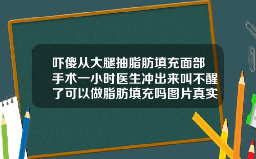 吓傻从大腿抽脂肪填充面部手术一小时医生冲出来叫不醒了可以做脂肪填充吗图片真实