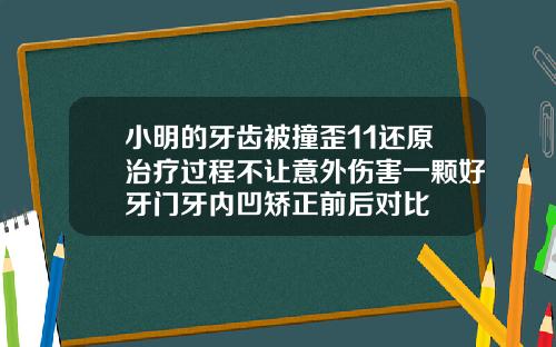 小明的牙齿被撞歪11还原治疗过程不让意外伤害一颗好牙门牙内凹矫正前后对比