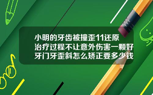 小明的牙齿被撞歪11还原治疗过程不让意外伤害一颗好牙门牙歪斜怎么矫正要多少钱