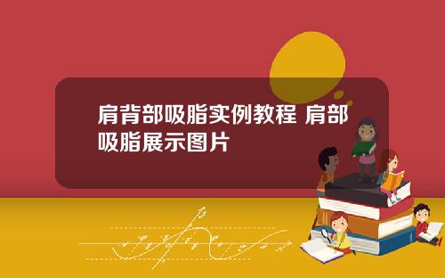 肩背部吸脂实例教程 肩部吸脂展示图片