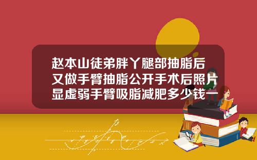 赵本山徒弟胖丫腿部抽脂后又做手臂抽脂公开手术后照片显虚弱手臂吸脂减肥多少钱一次