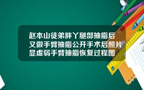 赵本山徒弟胖丫腿部抽脂后又做手臂抽脂公开手术后照片显虚弱手臂抽脂恢复过程图