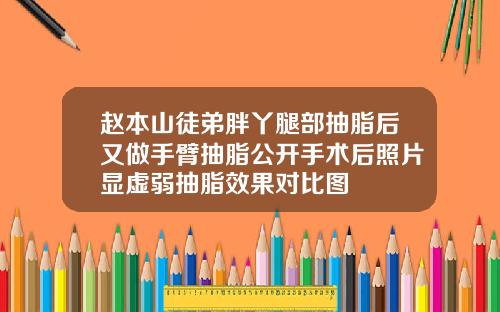赵本山徒弟胖丫腿部抽脂后又做手臂抽脂公开手术后照片显虚弱抽脂效果对比图