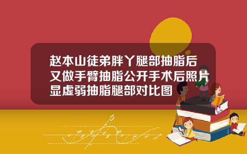 赵本山徒弟胖丫腿部抽脂后又做手臂抽脂公开手术后照片显虚弱抽脂腿部对比图