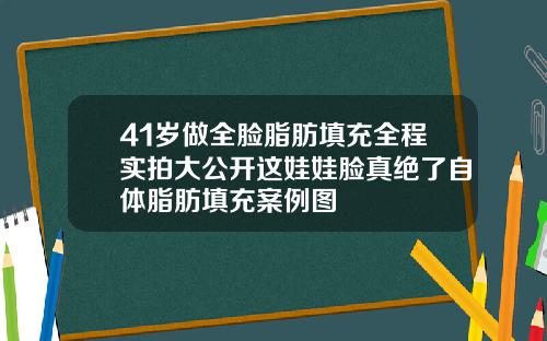 41岁做全脸脂肪填充全程实拍大公开这娃娃脸真绝了自体脂肪填充案例图