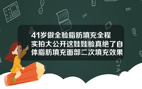 41岁做全脸脂肪填充全程实拍大公开这娃娃脸真绝了自体脂肪填充面部二次填充效果