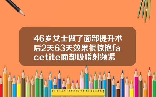 46岁女士做了面部提升术后2天63天效果很惊艳facetite面部吸脂射频紧肤多久自然