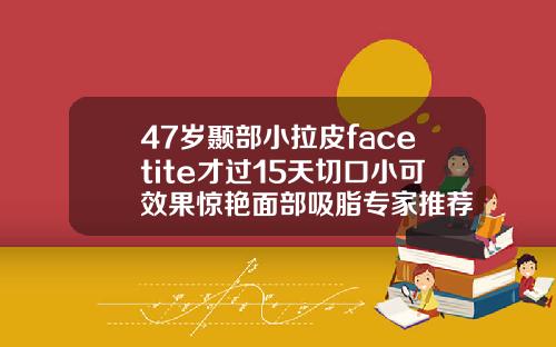 47岁颞部小拉皮facetite才过15天切口小可效果惊艳面部吸脂专家推荐