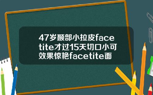 47岁颞部小拉皮facetite才过15天切口小可效果惊艳facetite面部吸脂射频紧肤多久自然