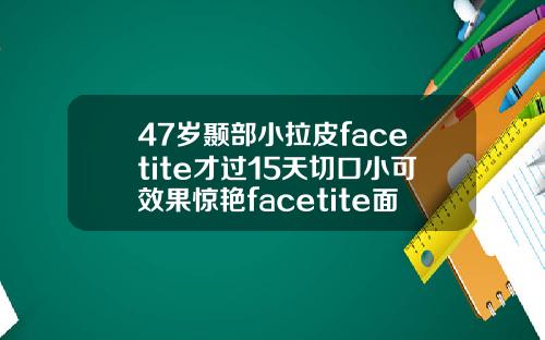 47岁颞部小拉皮facetite才过15天切口小可效果惊艳facetite面部吸脂