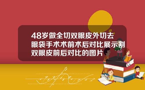 48岁做全切双眼皮外切去眼袋手术术前术后对比展示割双眼皮前后对比的图片