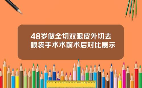 48岁做全切双眼皮外切去眼袋手术术前术后对比展示