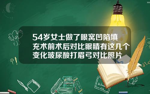 54岁女士做了眼窝凹陷填充术前术后对比眼睛有这几个变化玻尿酸打眉弓对比照片