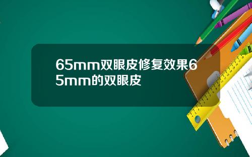 65mm双眼皮修复效果65mm的双眼皮
