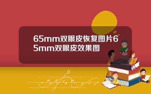65mm双眼皮恢复图片65mm双眼皮效果图